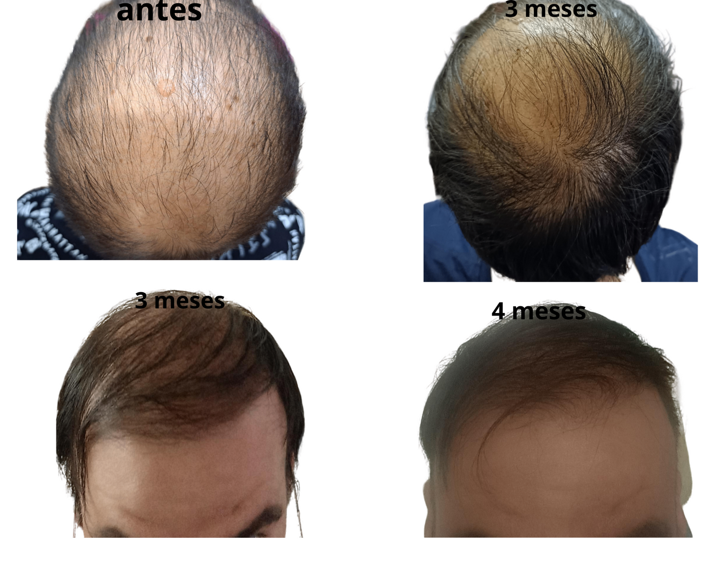 Tonico Capilar 100% NATURAL – Renueva tu cabello desde la raíz 250ml
